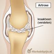 artrose knie
